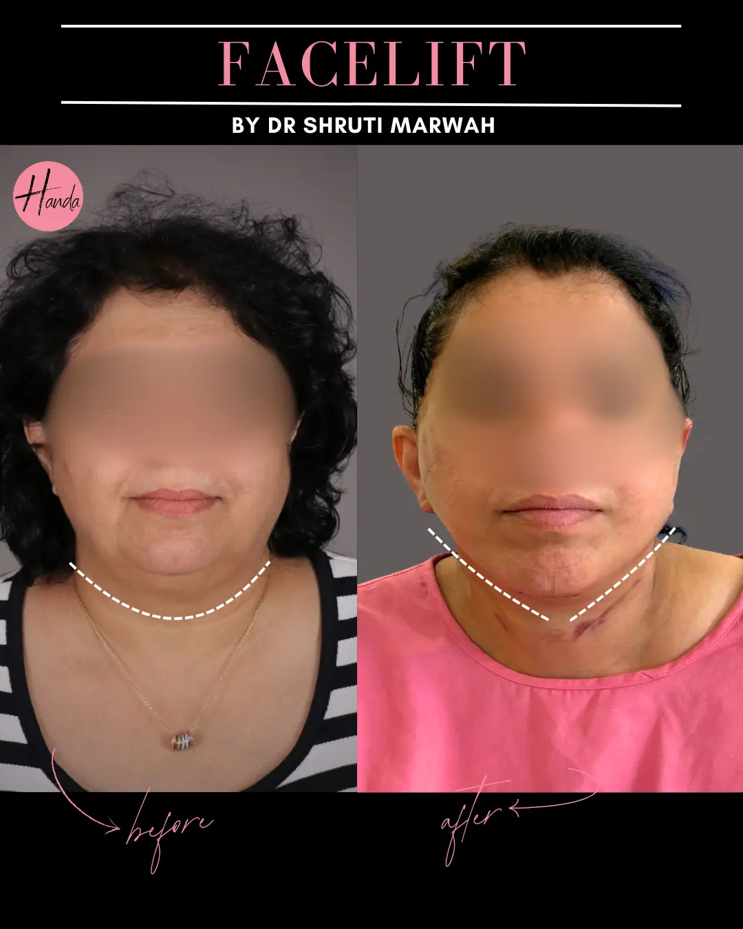 FACE LIFT before and after — Handa Aesthetics