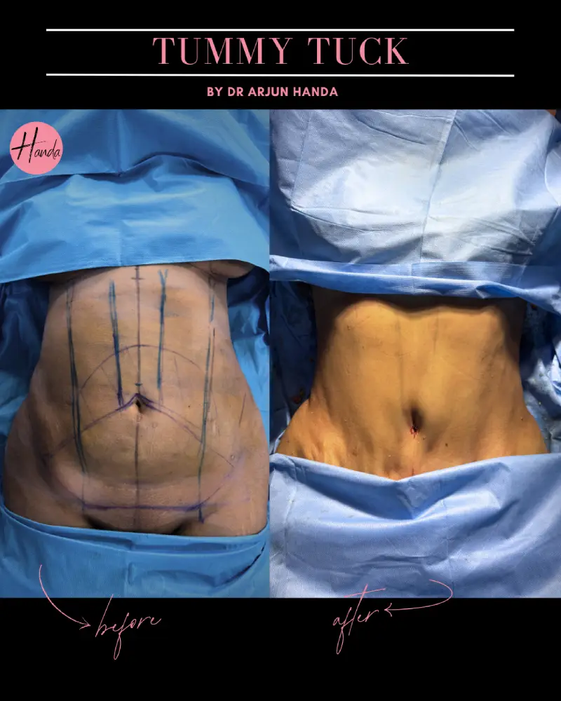 Tummy Tuck (Full Abdominoplasty) before and after — Handa Aesthetics