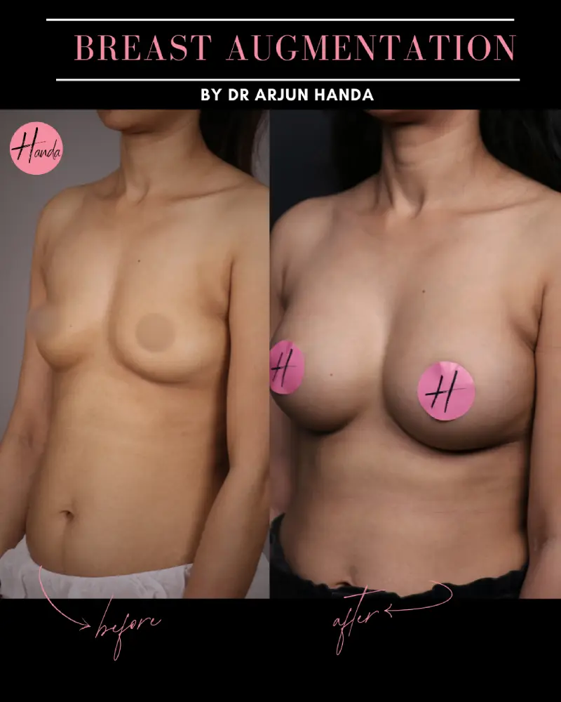 BREAST AUGMENTATION before and after — Handa Aesthetics