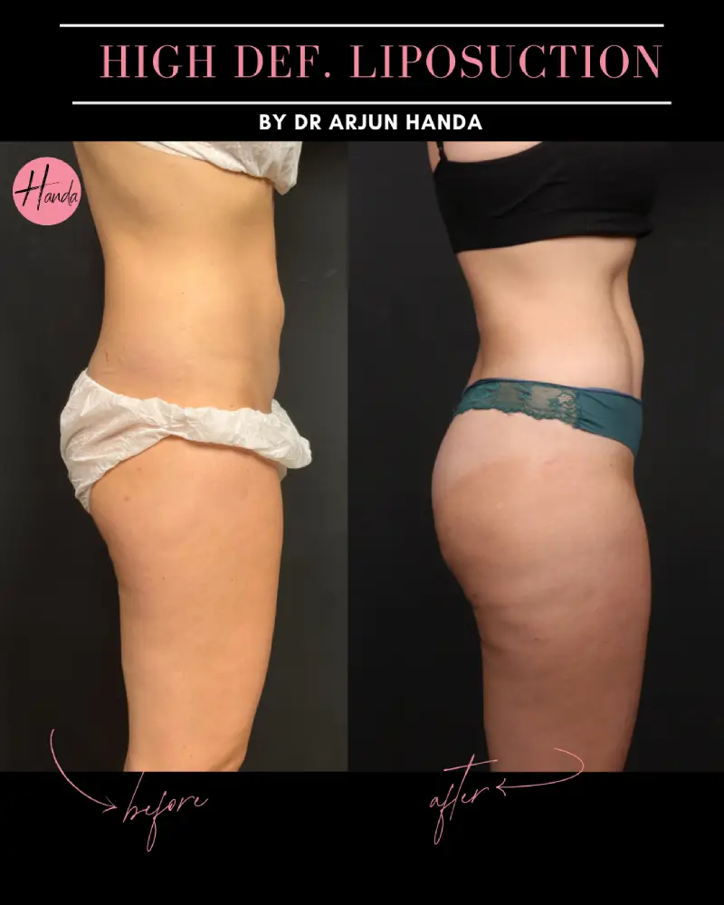 Liposuction before and after — Handa Aesthetics
