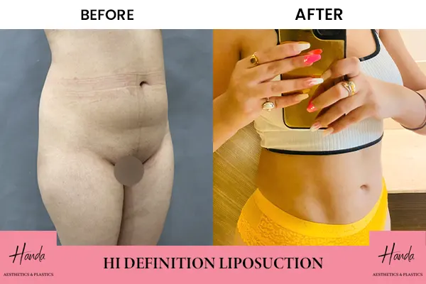 Liposuction before and after — Handa Aesthetics