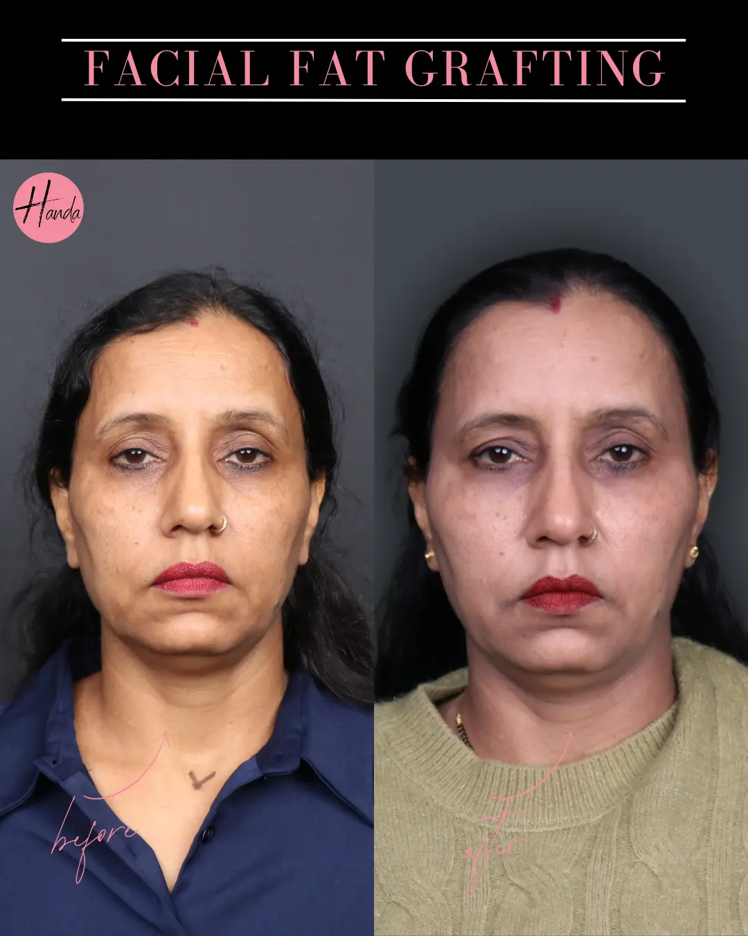 FACIAL FAT GRAFTING before and after — Handa Aesthetics