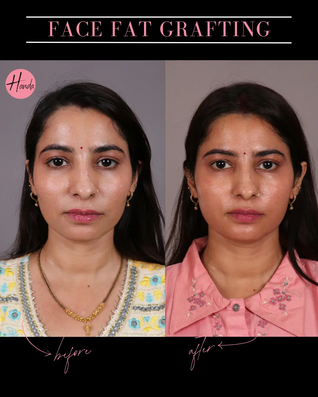 FACIAL FAT GRAFTING before and after — Handa Aesthetics