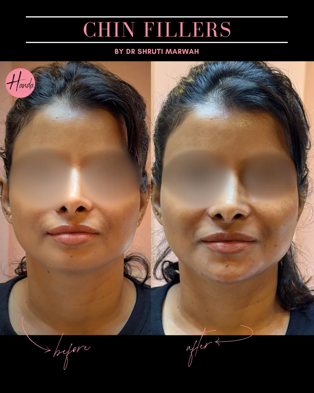 CHIN & LIP FILLERS before and after — Handa Aesthetics