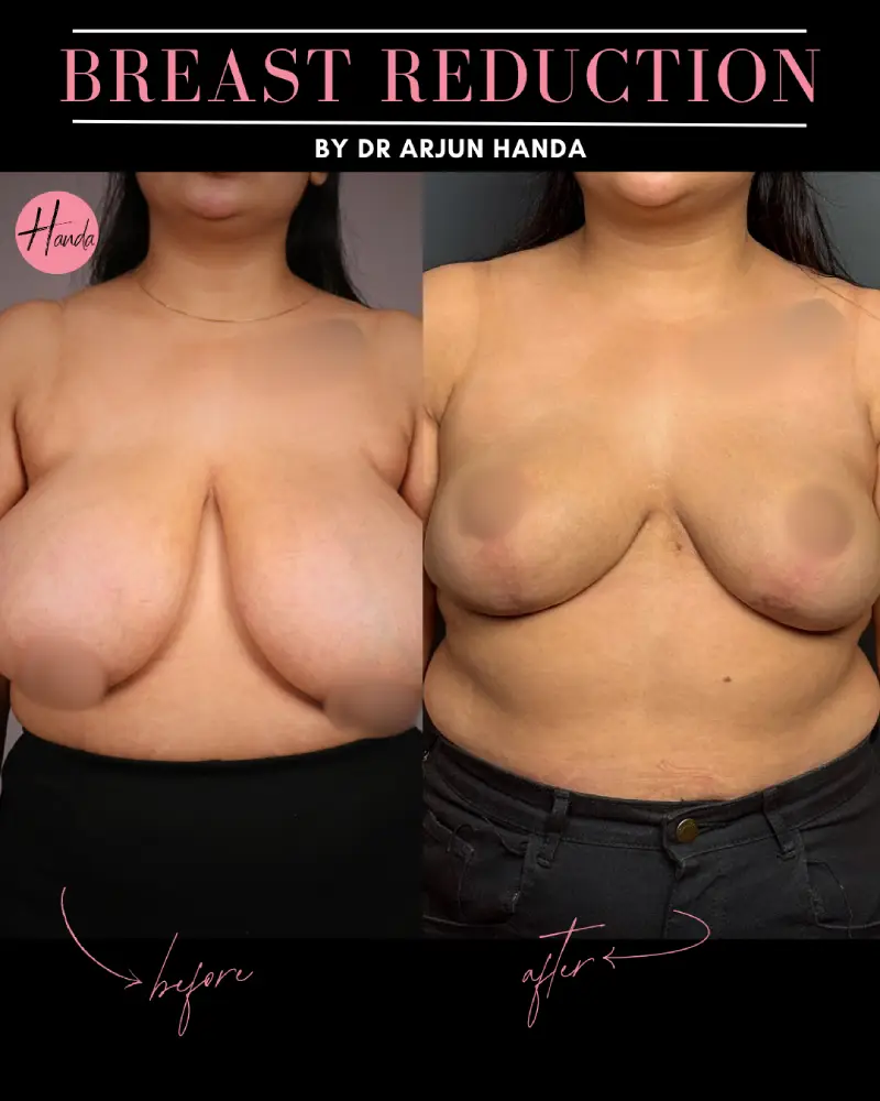 BREAST REDUCTION AND LIFT before and after — Handa Aesthetics