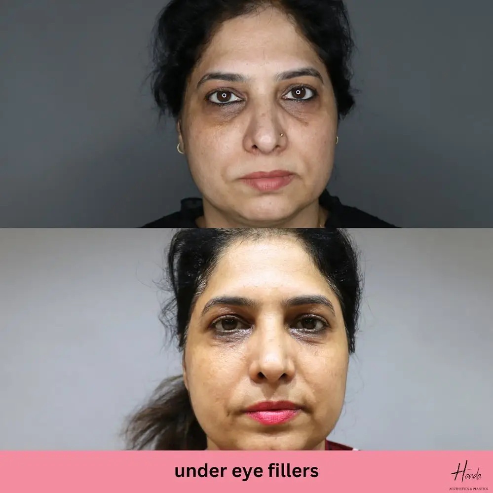 Face before and after — Handa Aesthetics