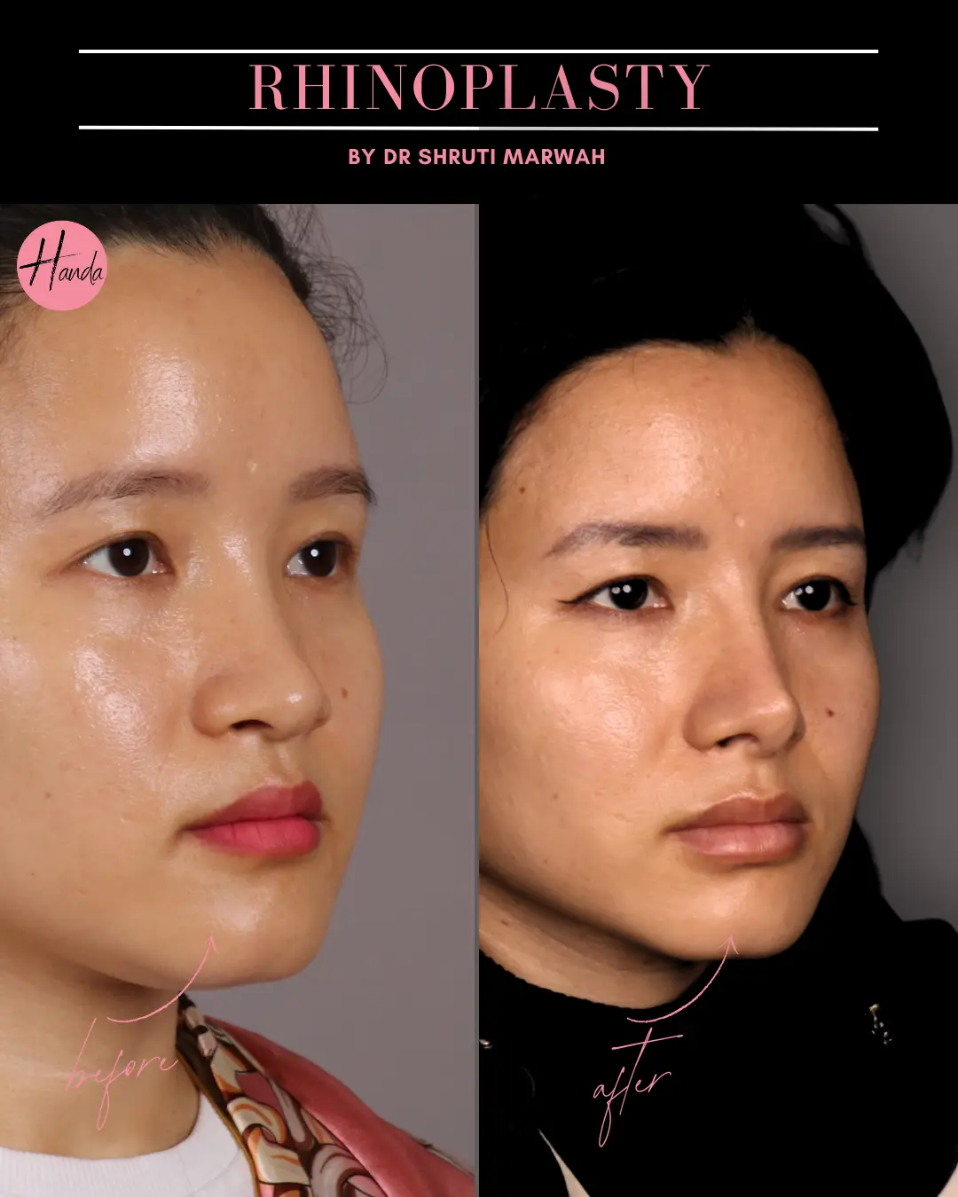 RHINOPLASTY before and after — Handa Aesthetics