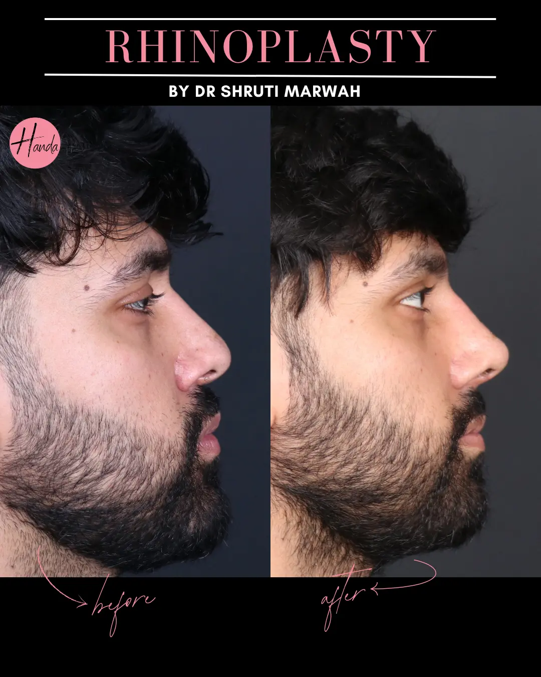 RHINOPLASTY before and after — Handa Aesthetics