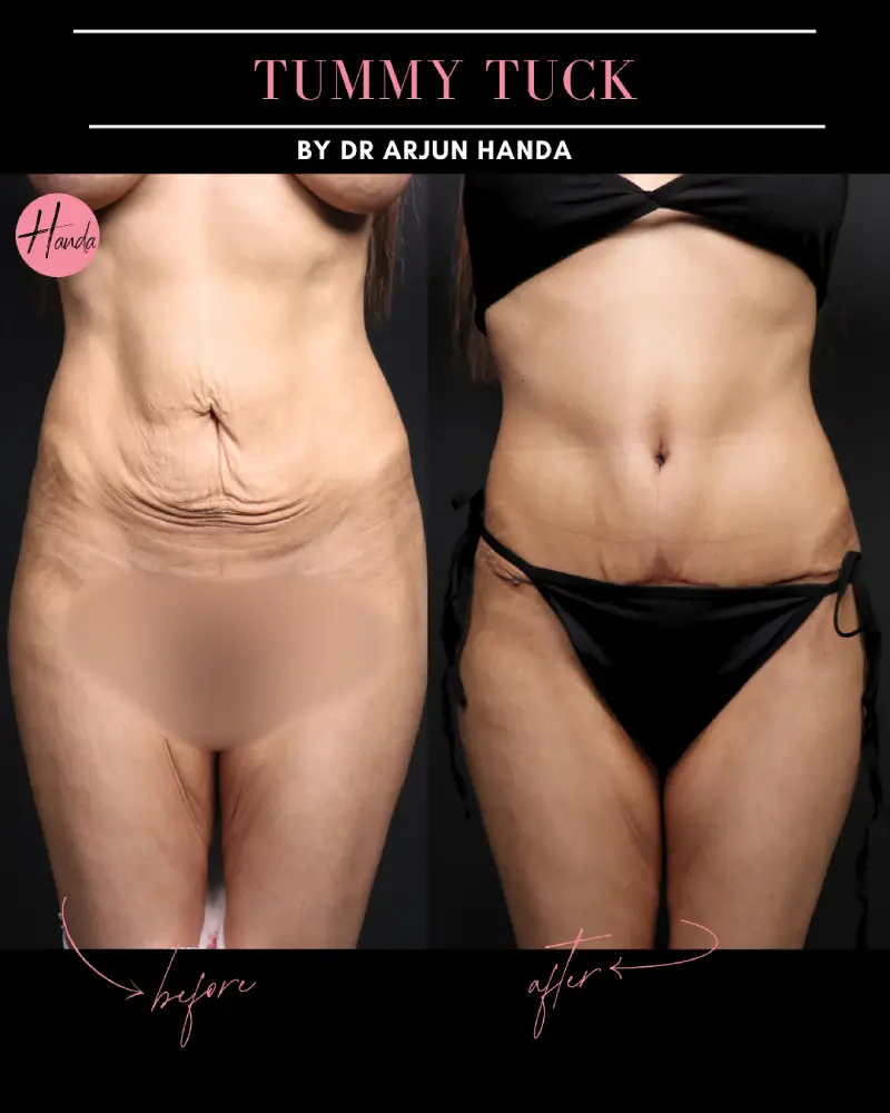 Tummy Tuck (Full Abdominoplasty) before and after — Handa Aesthetics
