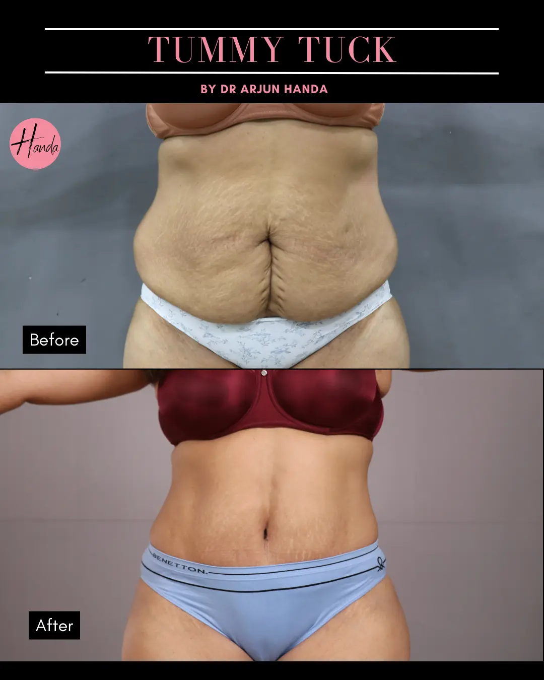 Tummy Tuck (Full Abdominoplasty) before and after — Handa Aesthetics