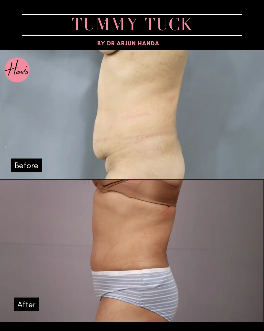Tummy Tuck (Full Abdominoplasty) before and after — Handa Aesthetics