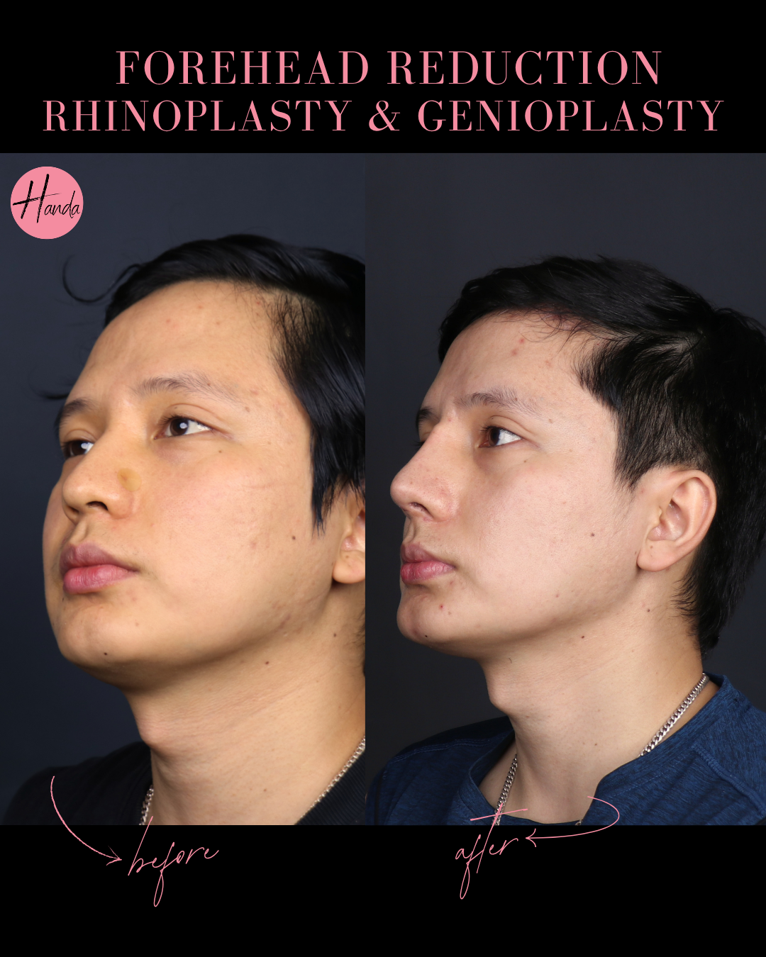 FOREHEAD REDUCTION, RHINOPLASTY & GENIOPLASTY before and after — Handa Aesthetics