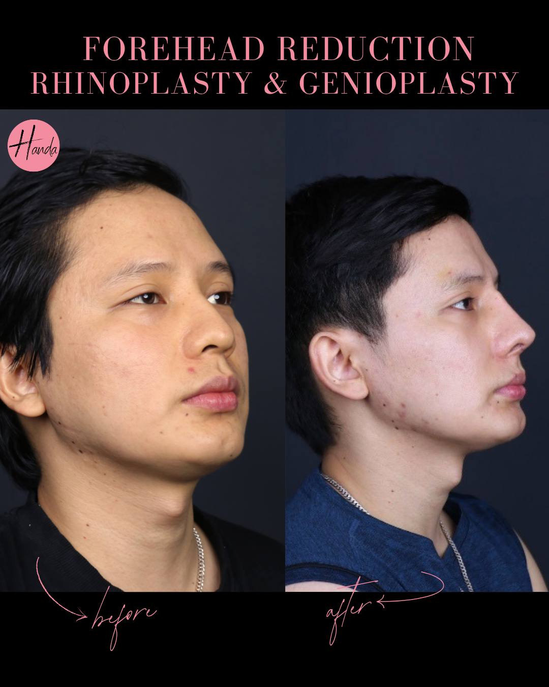 FOREHEAD REDUCTION, RHINOPLASTY & GENIOPLASTY before and after — Handa Aesthetics