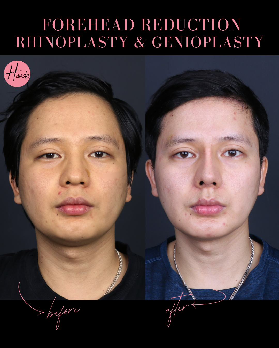 FOREHEAD REDUCTION, RHINOPLASTY & GENIOPLASTY before and after — Handa Aesthetics