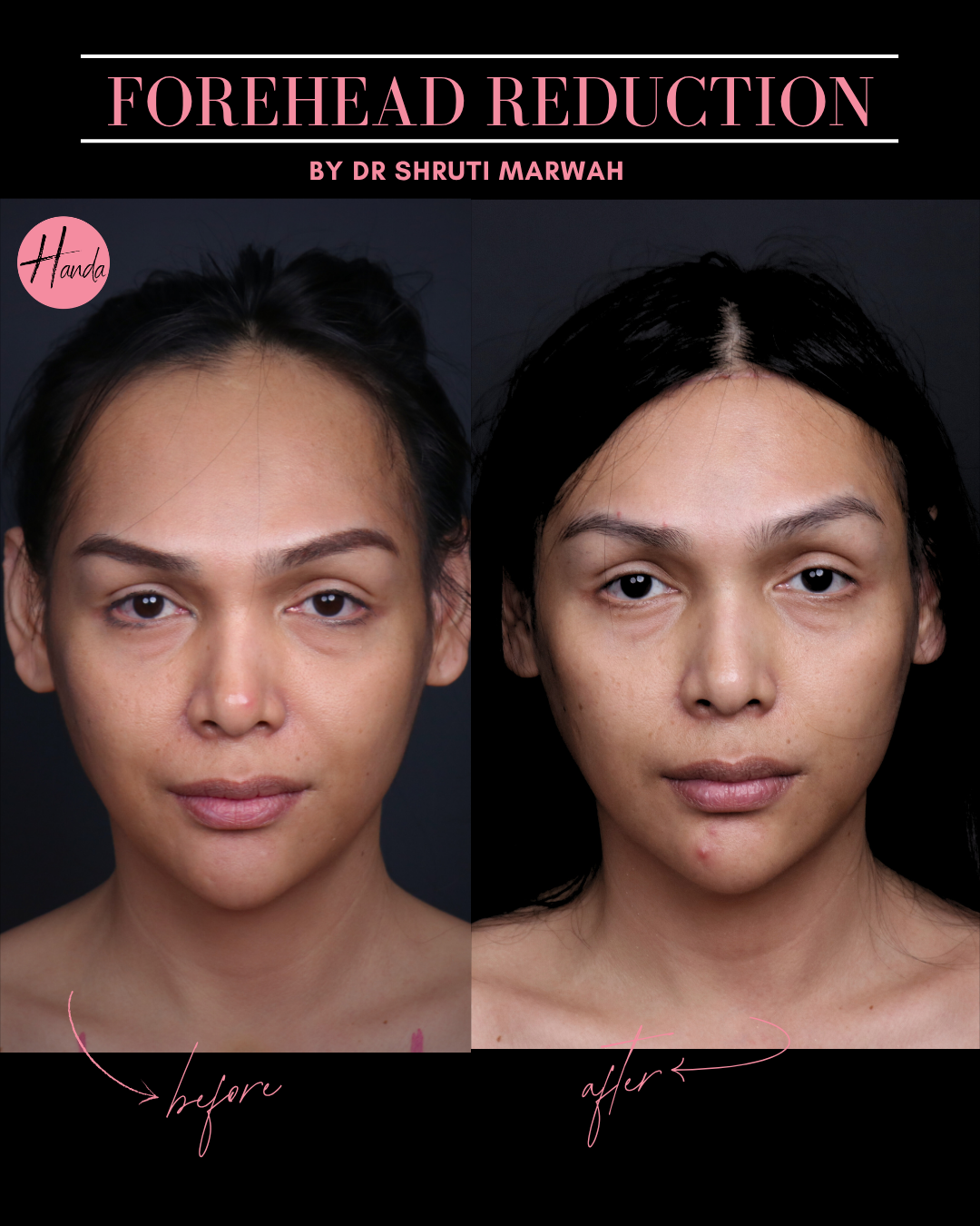 FOREHEAD REDUCTION before and after — Handa Aesthetics