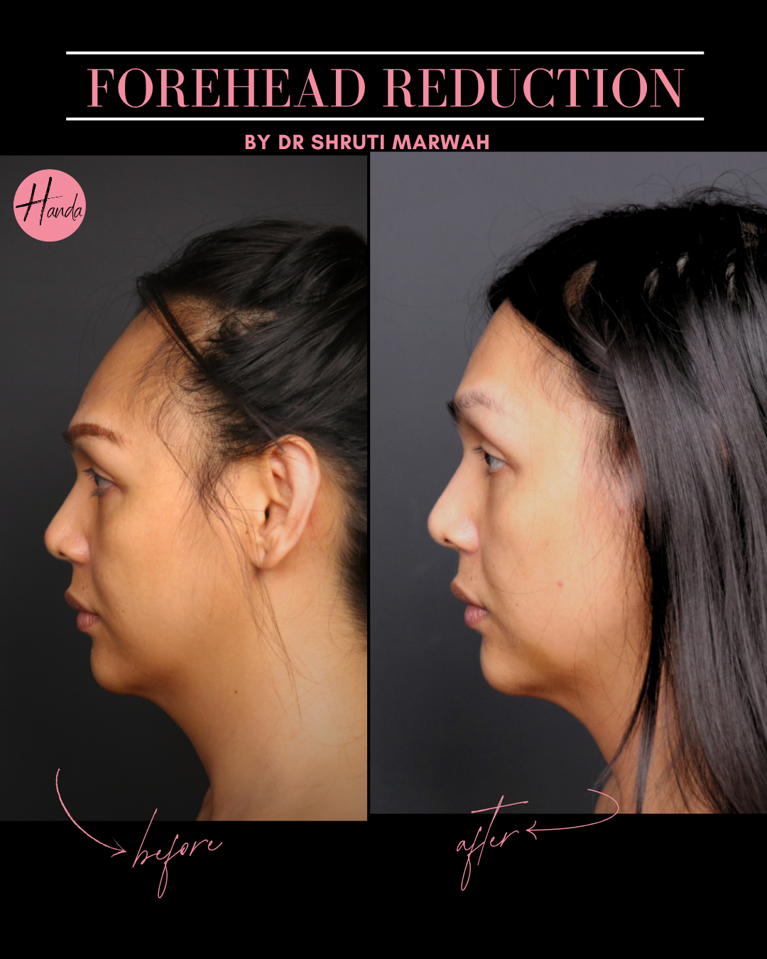 FOREHEAD REDUCTION before and after — Handa Aesthetics