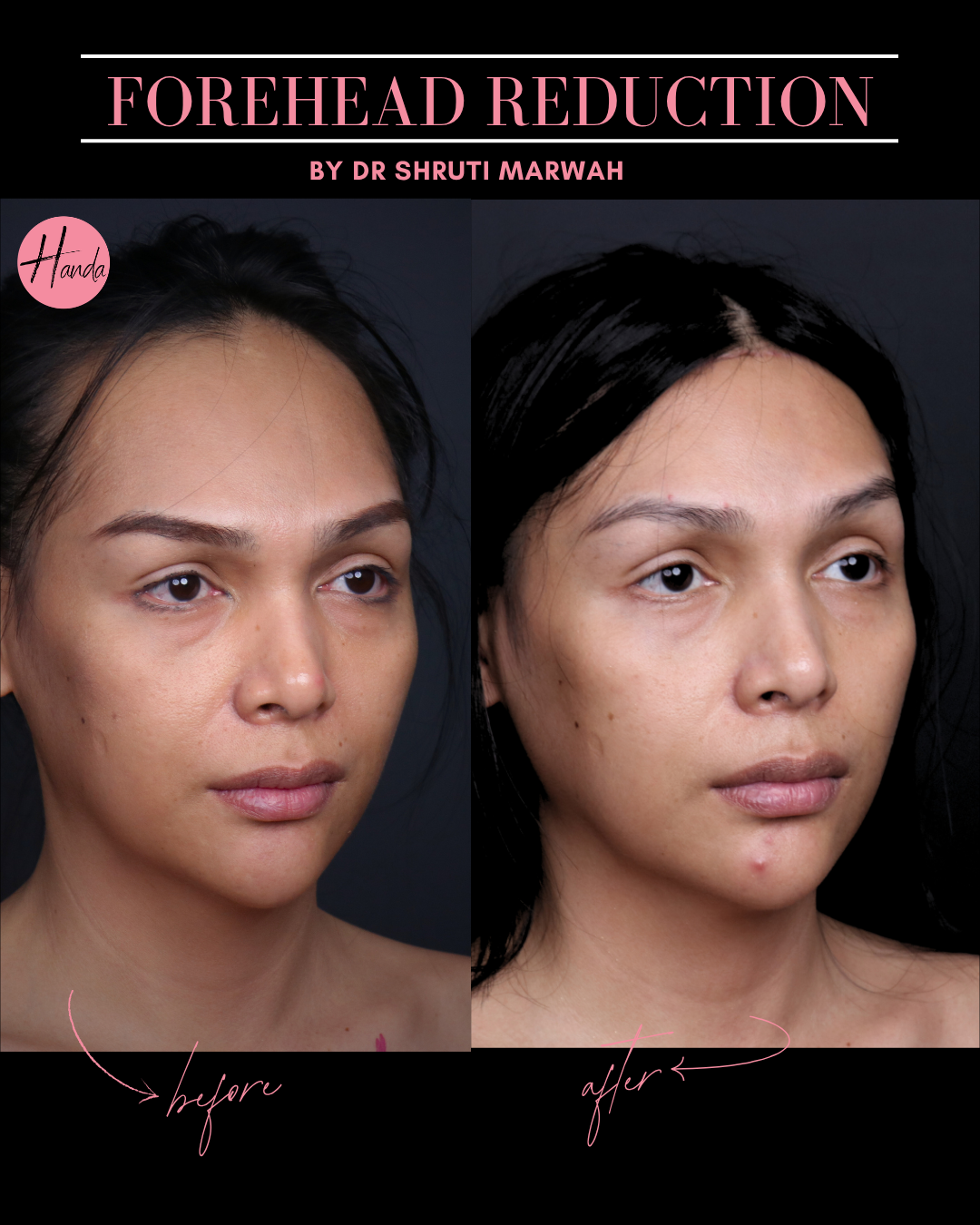 Latest patient result — Handa Aesthetics