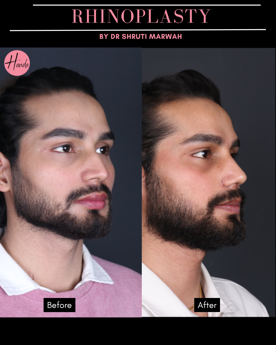 RHINOPLASTY before and after — Handa Aesthetics