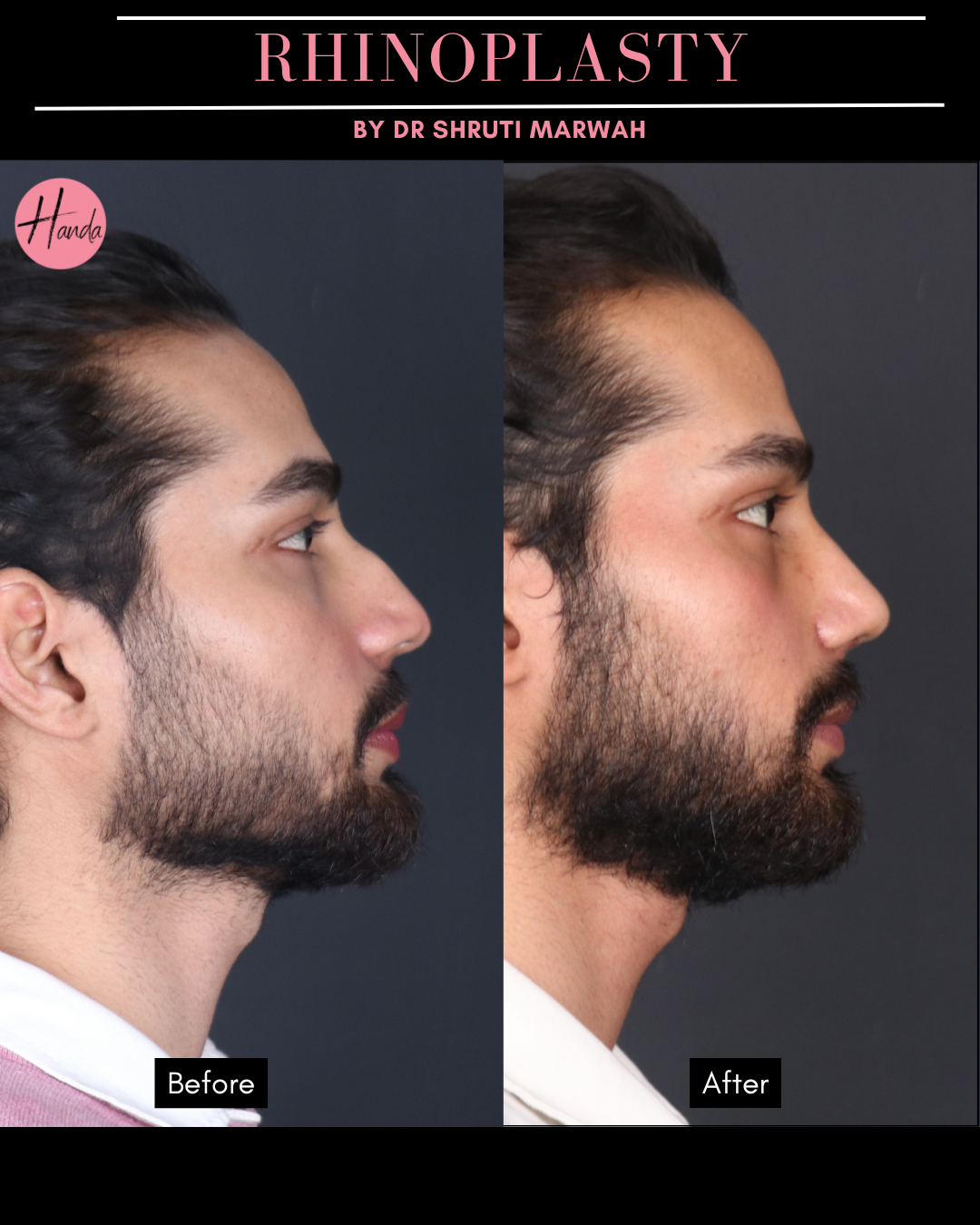 RHINOPLASTY before and after — Handa Aesthetics