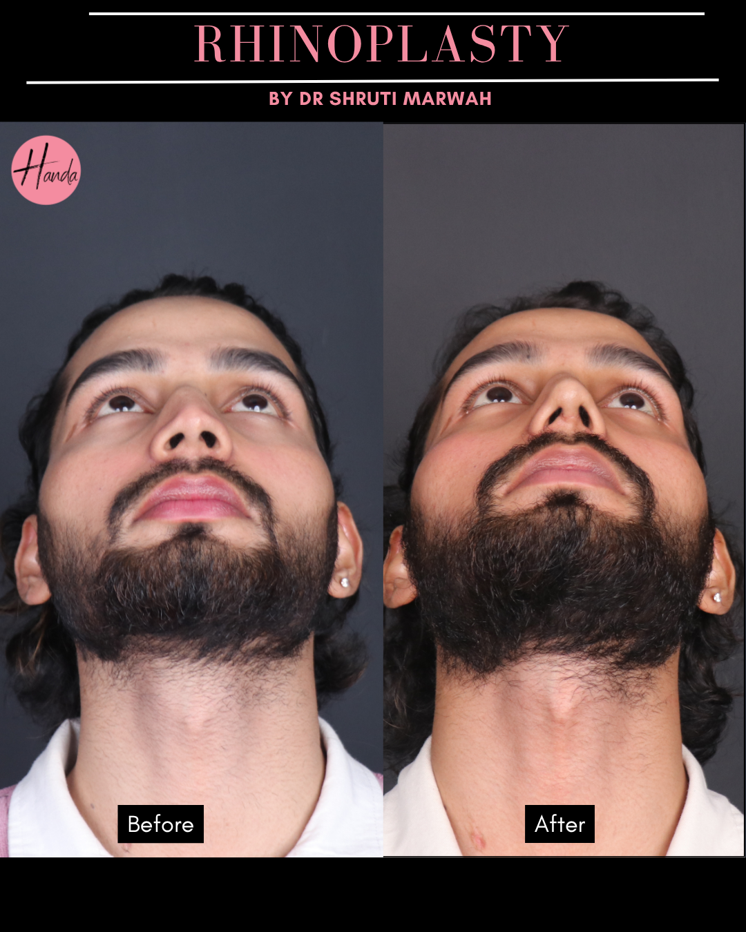 RHINOPLASTY before and after — Handa Aesthetics