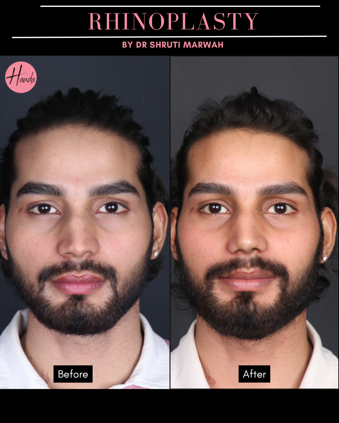 RHINOPLASTY before and after — Handa Aesthetics