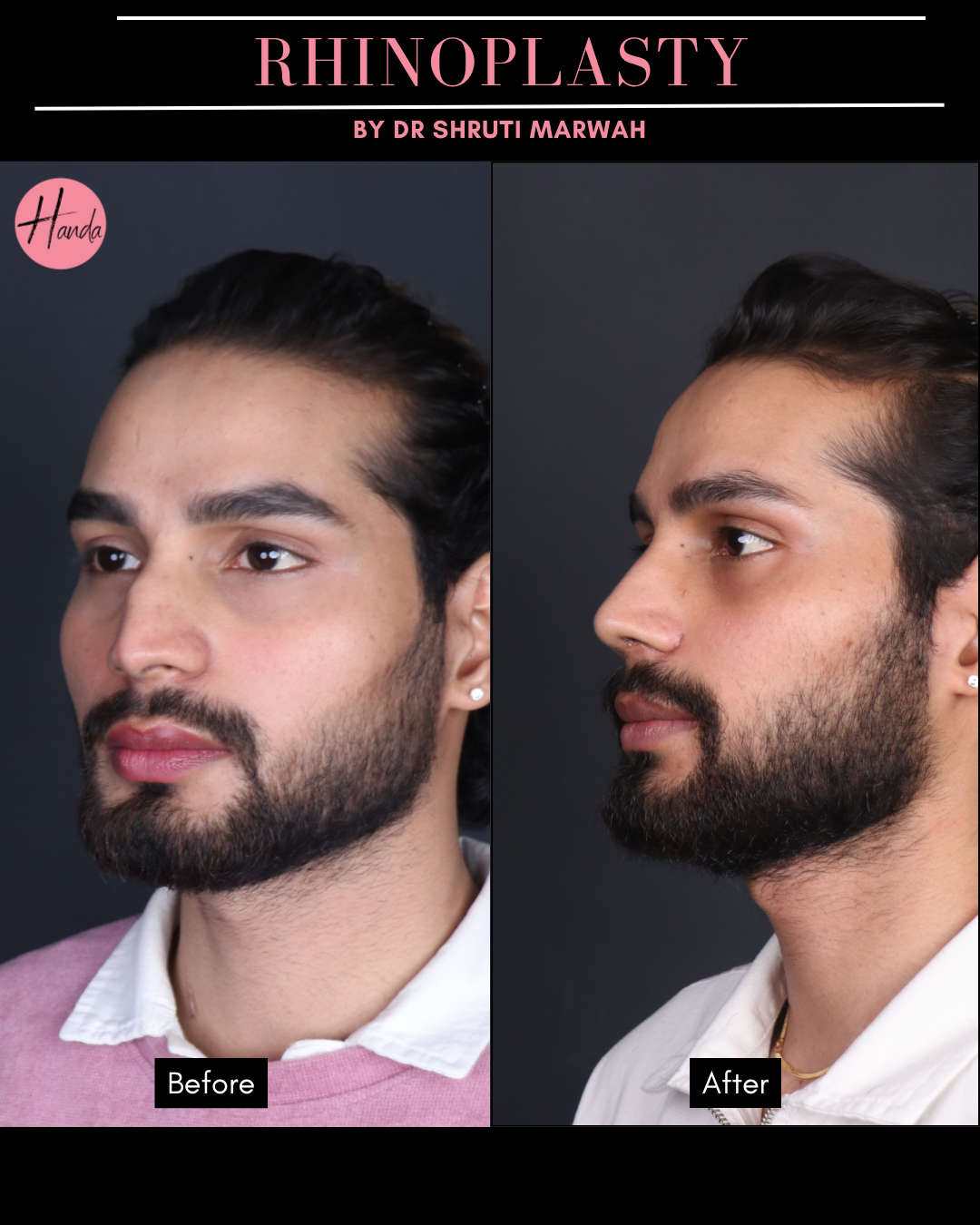 RHINOPLASTY before and after — Handa Aesthetics