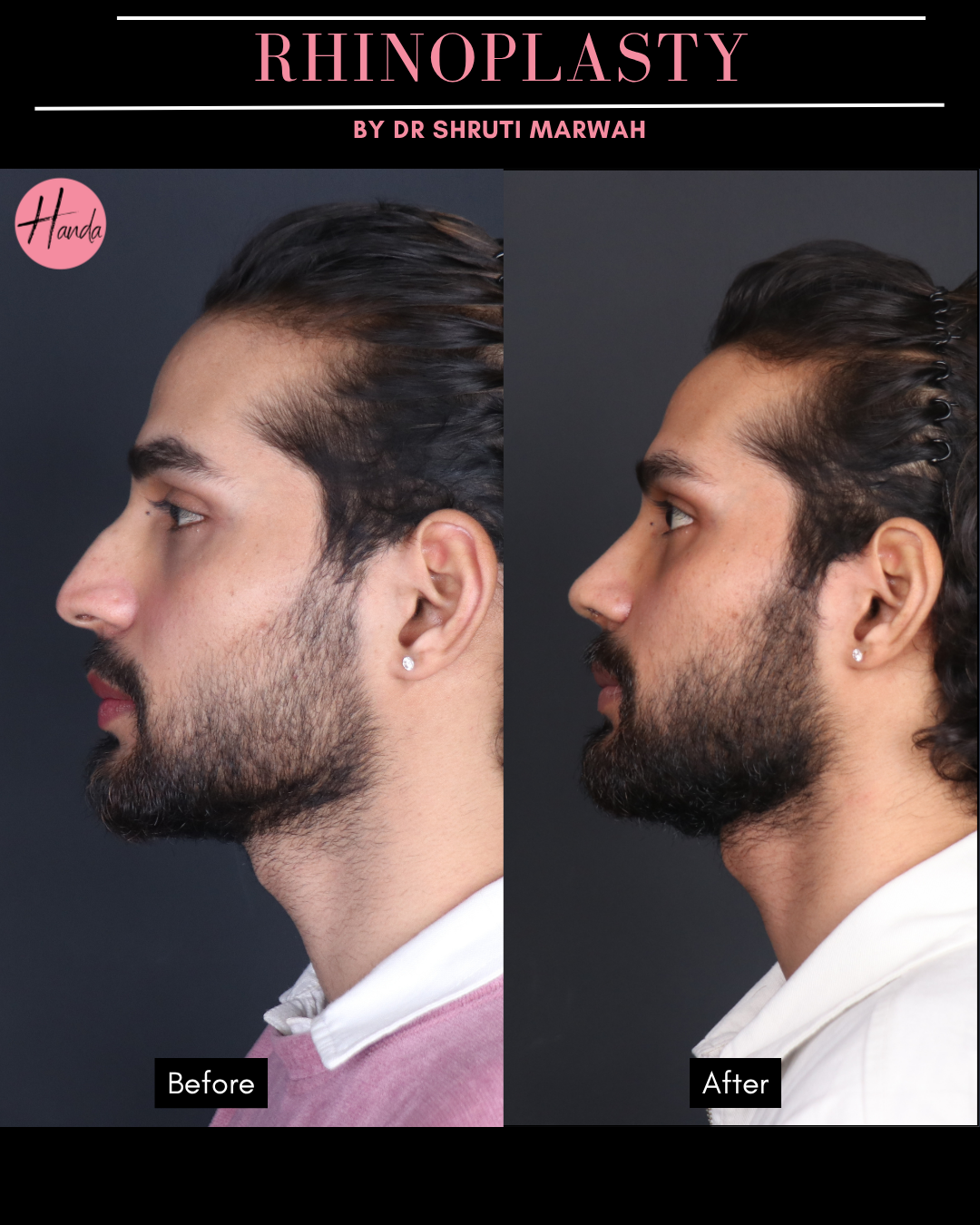 RHINOPLASTY before and after — Handa Aesthetics