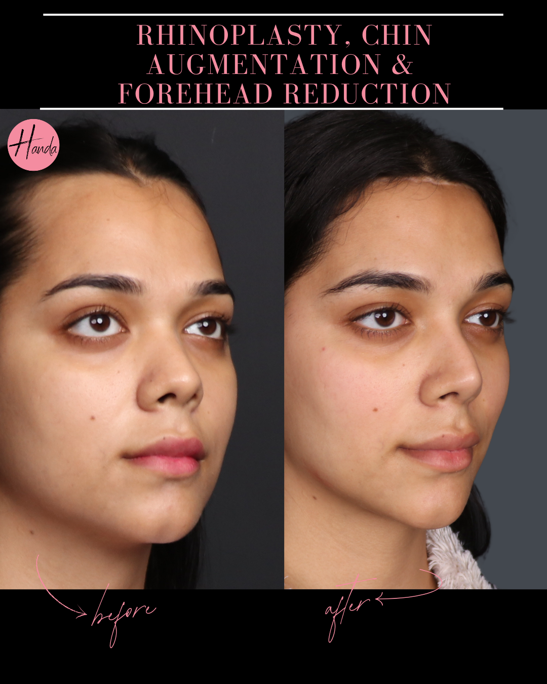 RHINOPLASTY, CHIN AUGMENTATION & FOREHEAD REDUCTION before and after — Handa Aesthetics