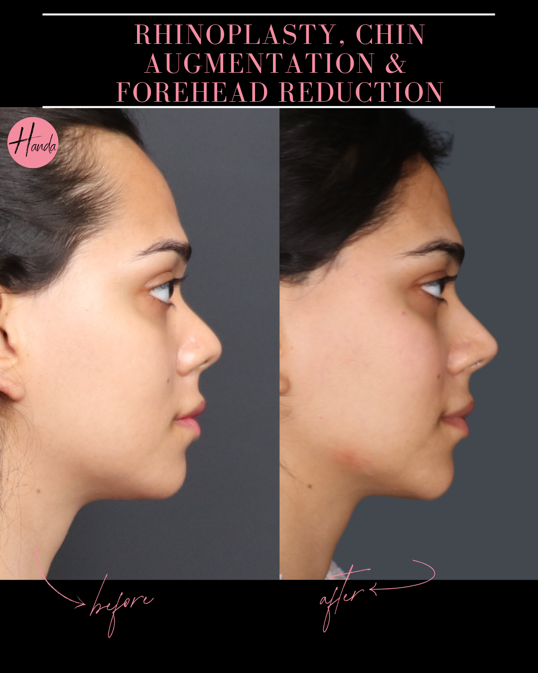 RHINOPLASTY, CHIN AUGMENTATION & FOREHEAD REDUCTION before and after — Handa Aesthetics