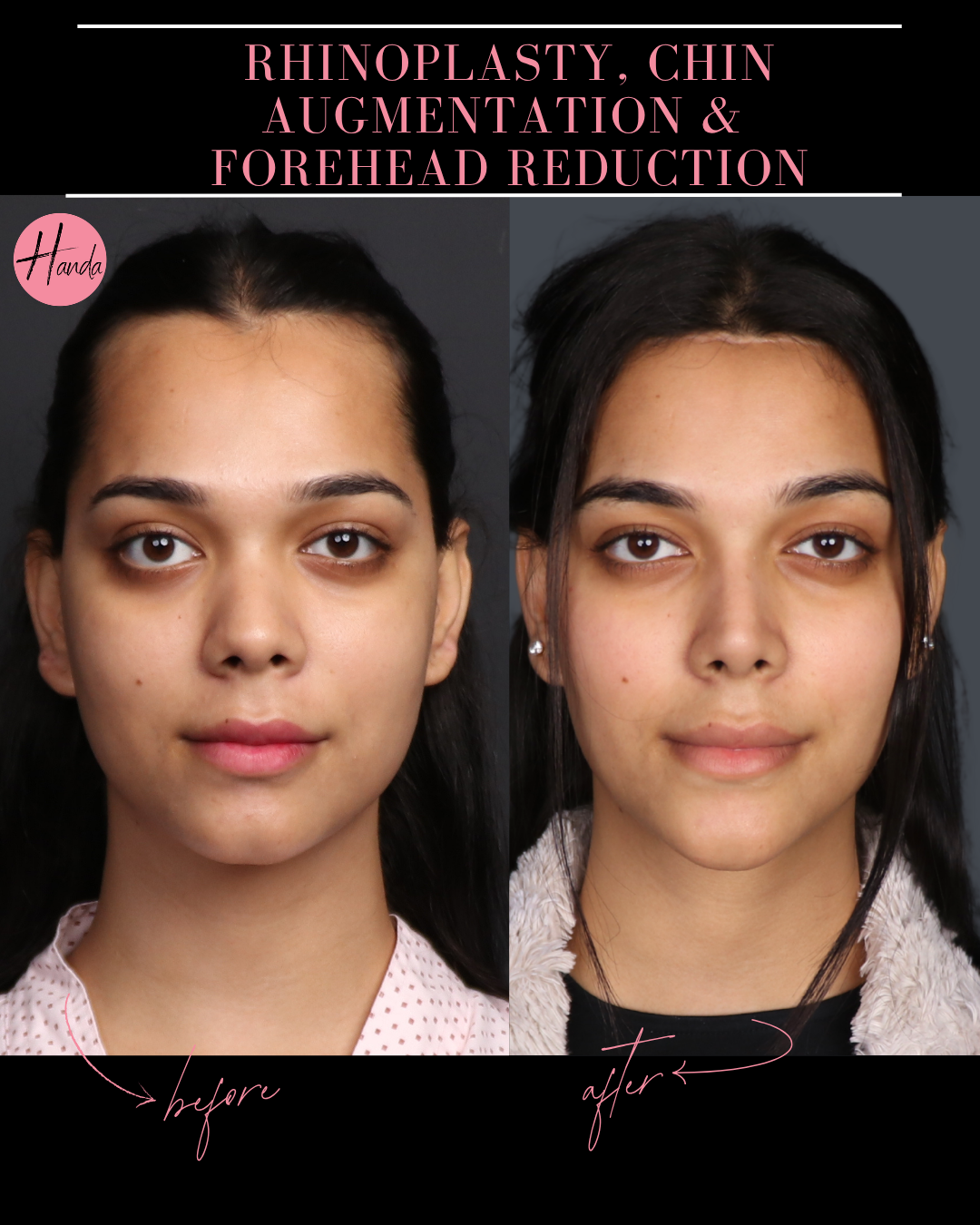 RHINOPLASTY, CHIN AUGMENTATION & FOREHEAD REDUCTION before and after — Handa Aesthetics