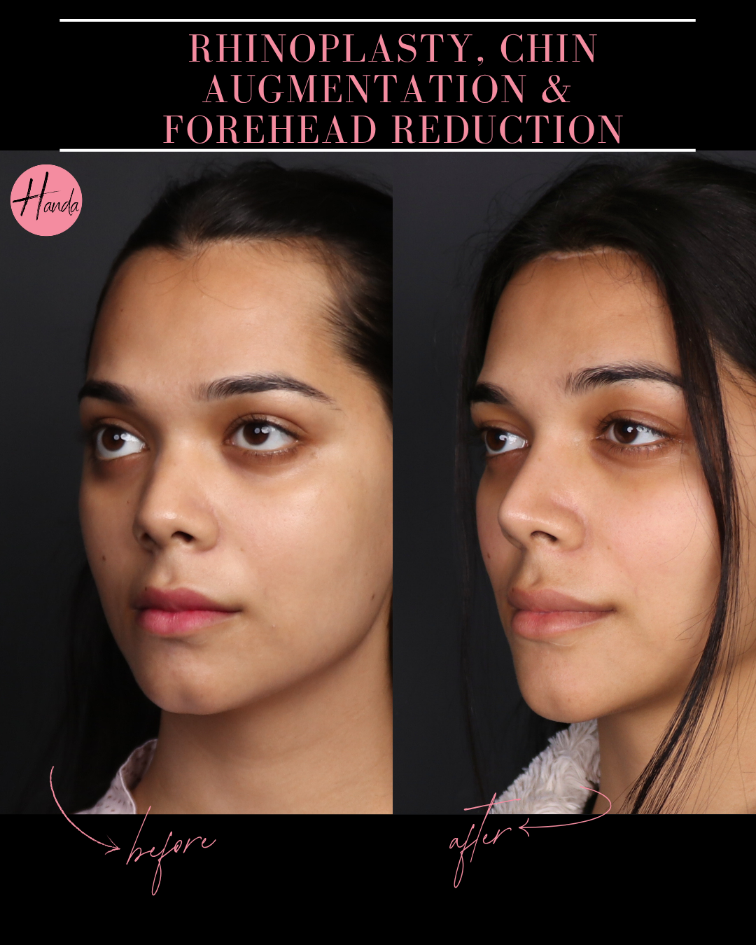 RHINOPLASTY, CHIN AUGMENTATION & FOREHEAD REDUCTION before and after — Handa Aesthetics