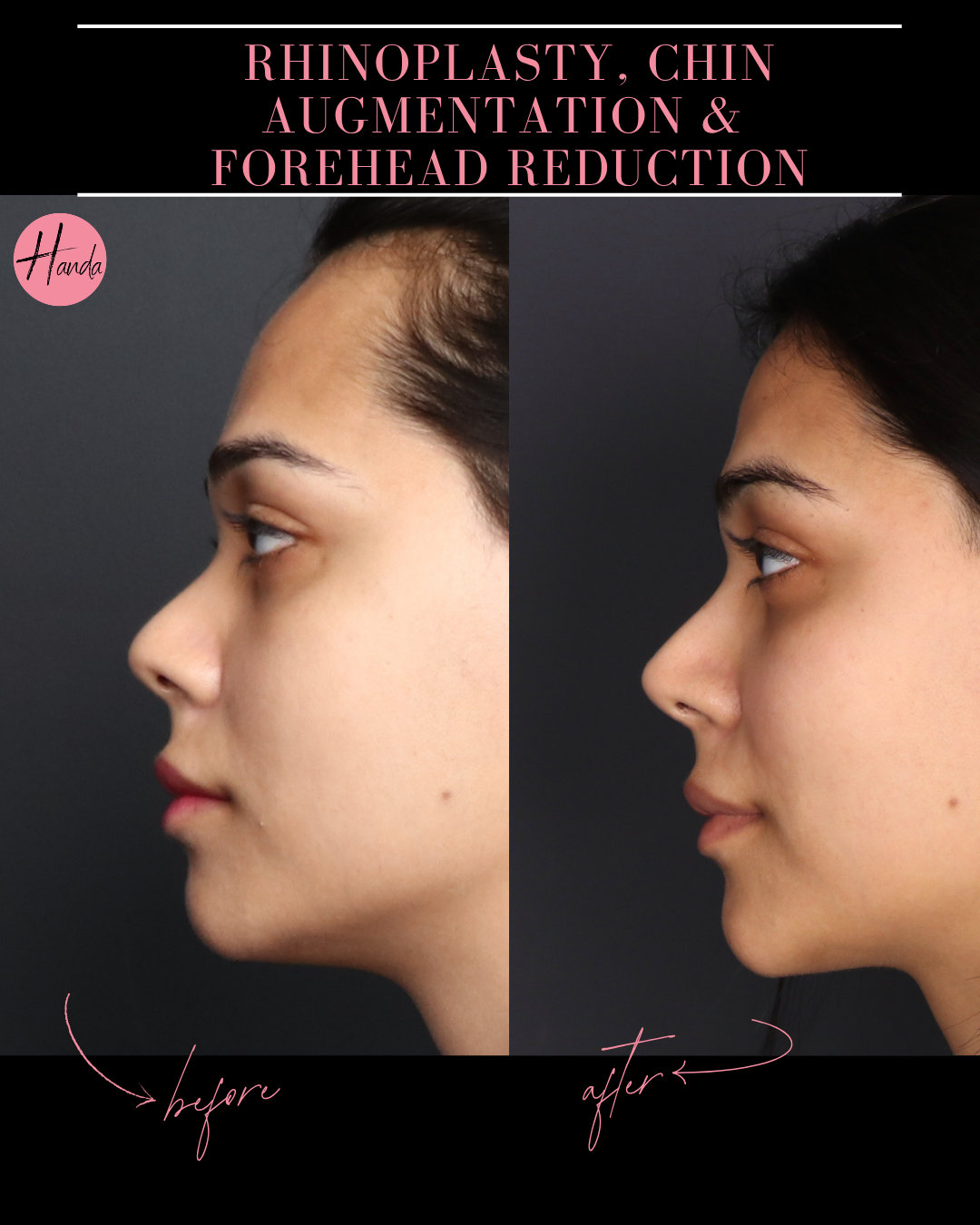 RHINOPLASTY, CHIN AUGMENTATION & FOREHEAD REDUCTION before and after — Handa Aesthetics