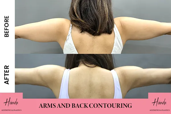 Arms & Thighs Lift before and after — Handa Aesthetics