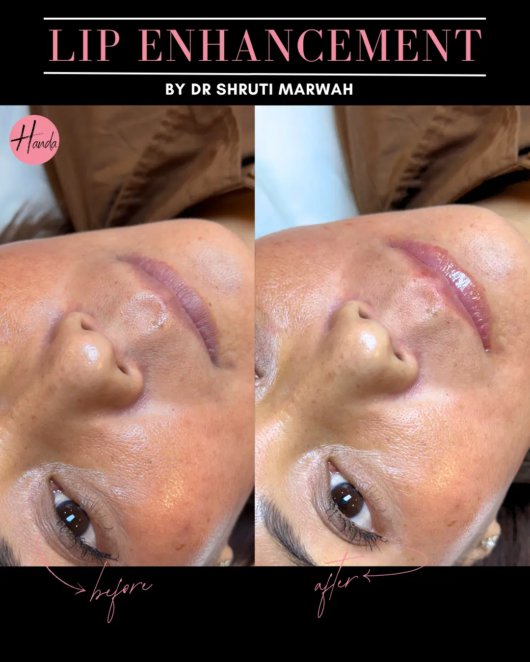 Body Contouring before and after — Handa Aesthetics