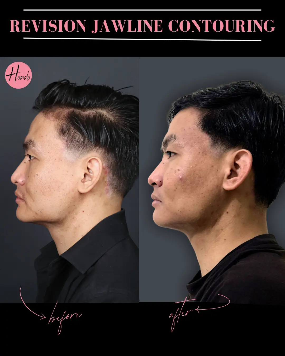 CHIN & JAWLINE LIPOSUCTION before and after — Handa Aesthetics