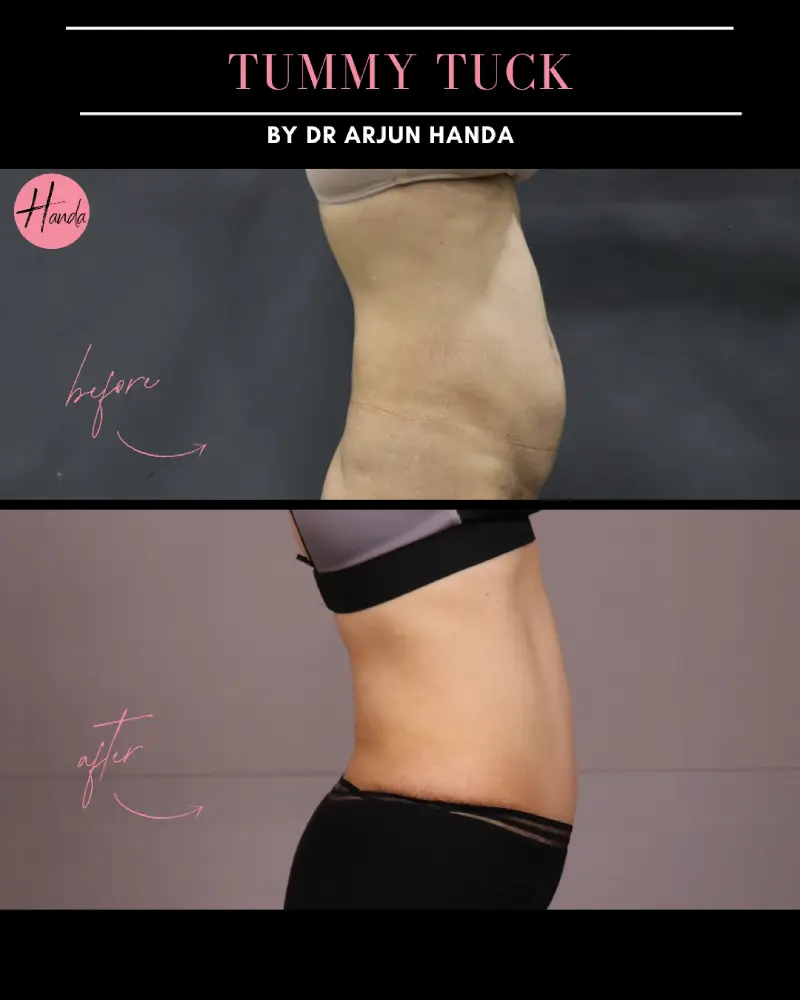 Tummy Tuck (Full Abdominoplasty) before and after — Handa Aesthetics