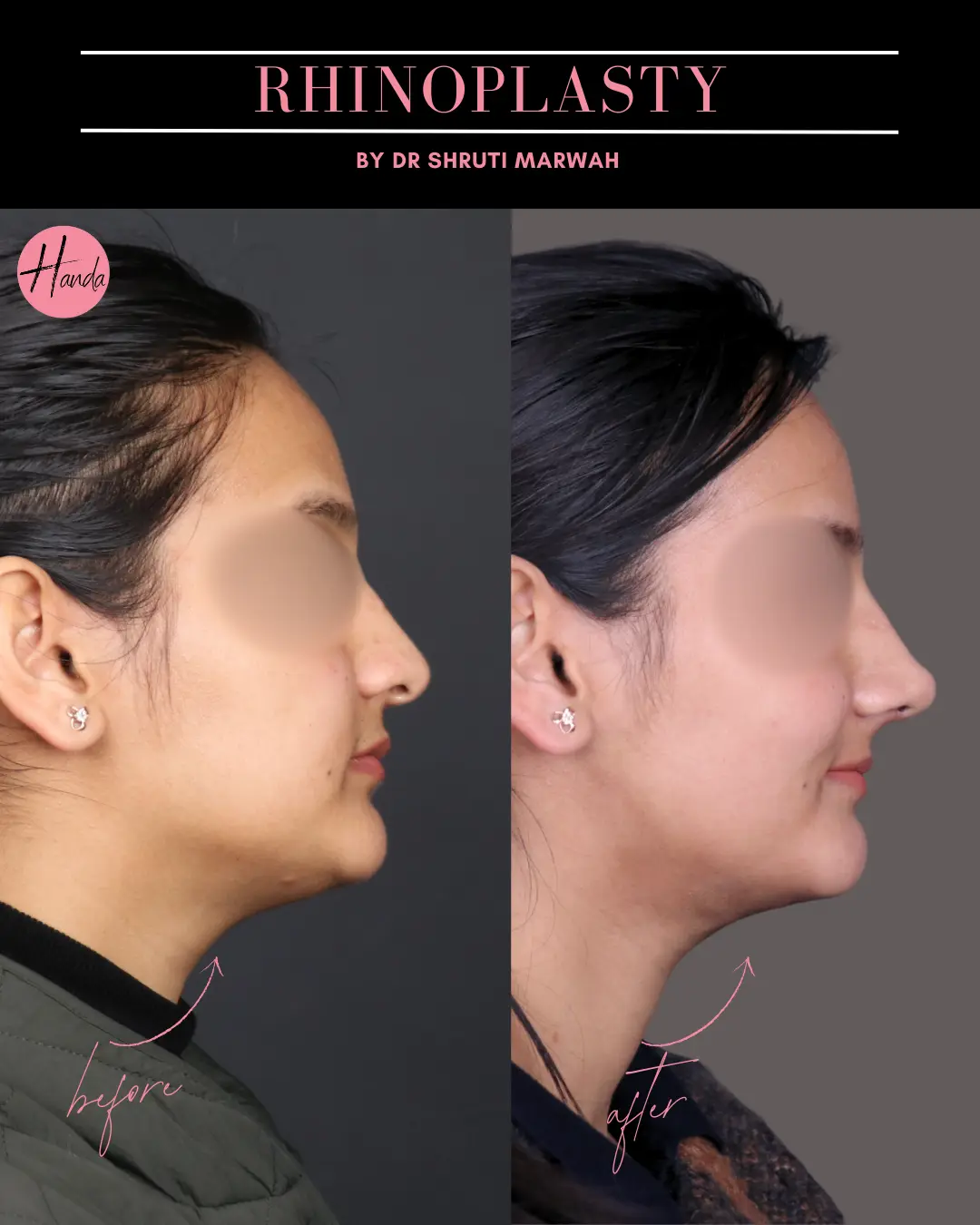 RHINOPLASTY before and after — Handa Aesthetics