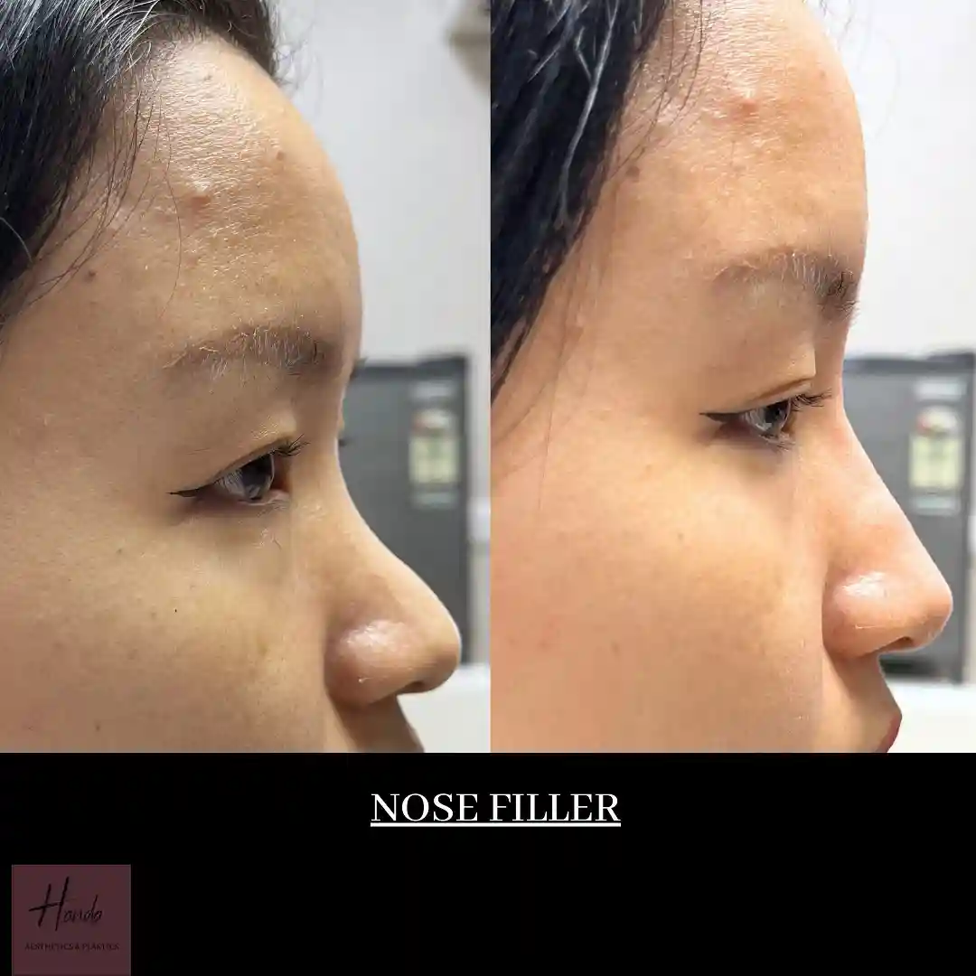 Face before and after — Handa Aesthetics