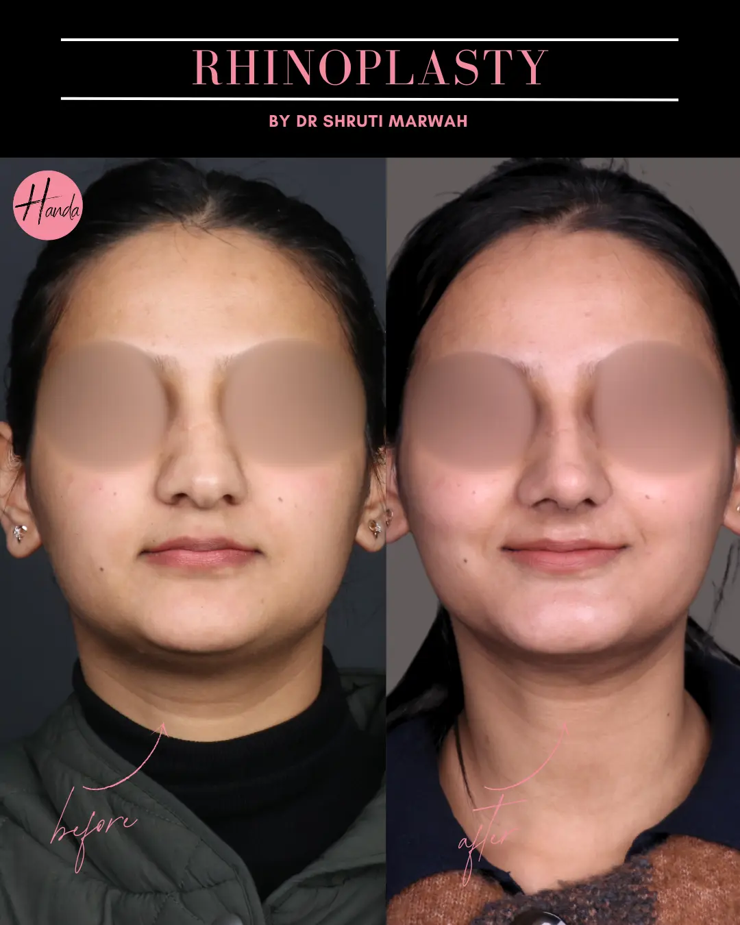 RHINOPLASTY before and after — Handa Aesthetics