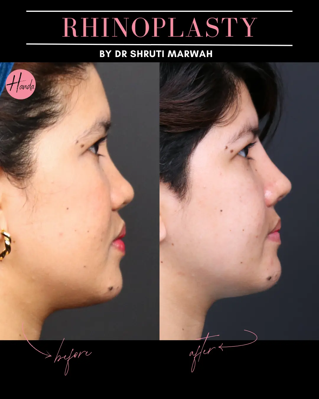 RHINOPLASTY before and after — Handa Aesthetics