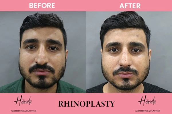 RHINOPLASTY before and after — Handa Aesthetics