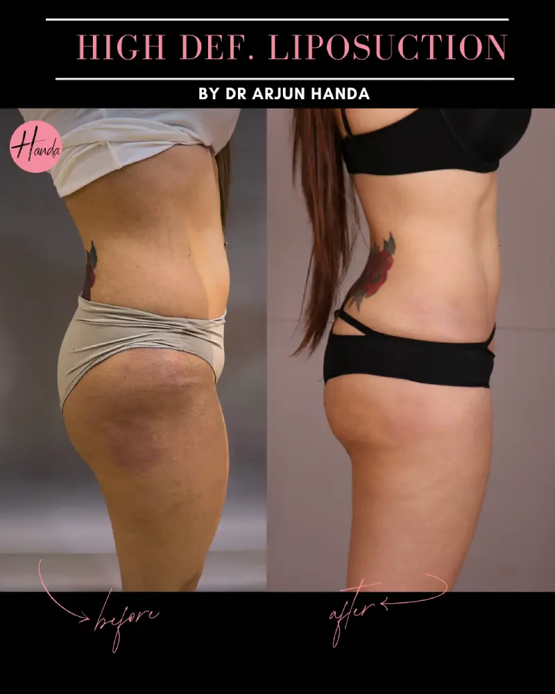 Liposuction before and after — Handa Aesthetics