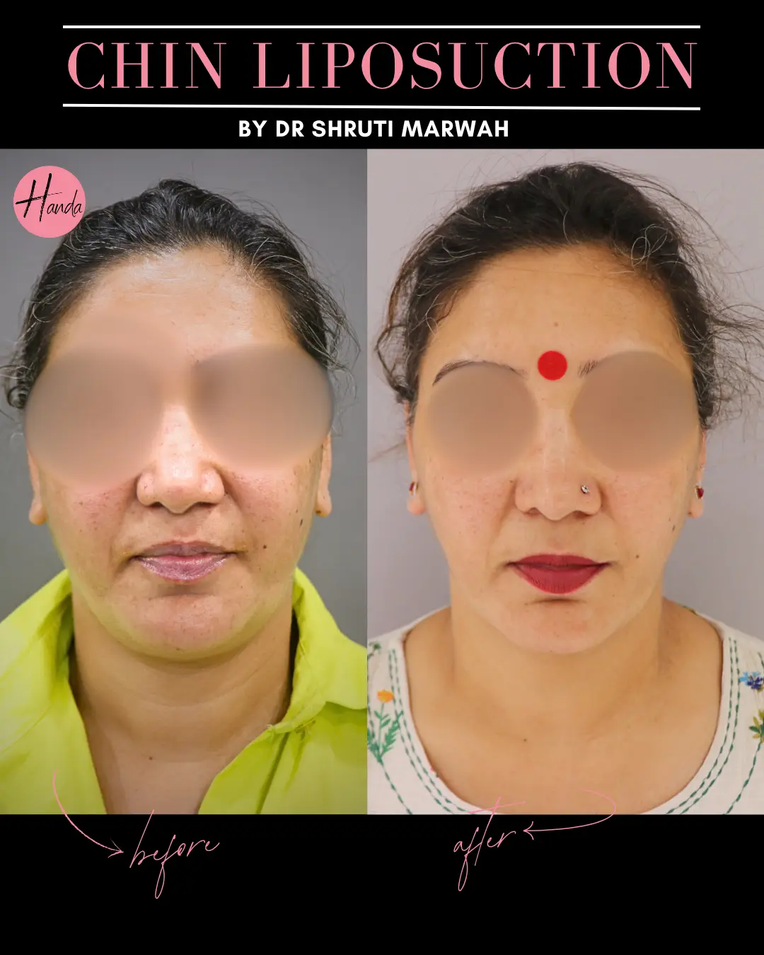 CHIN & JAWLINE LIPOSUCTION before and after — Handa Aesthetics