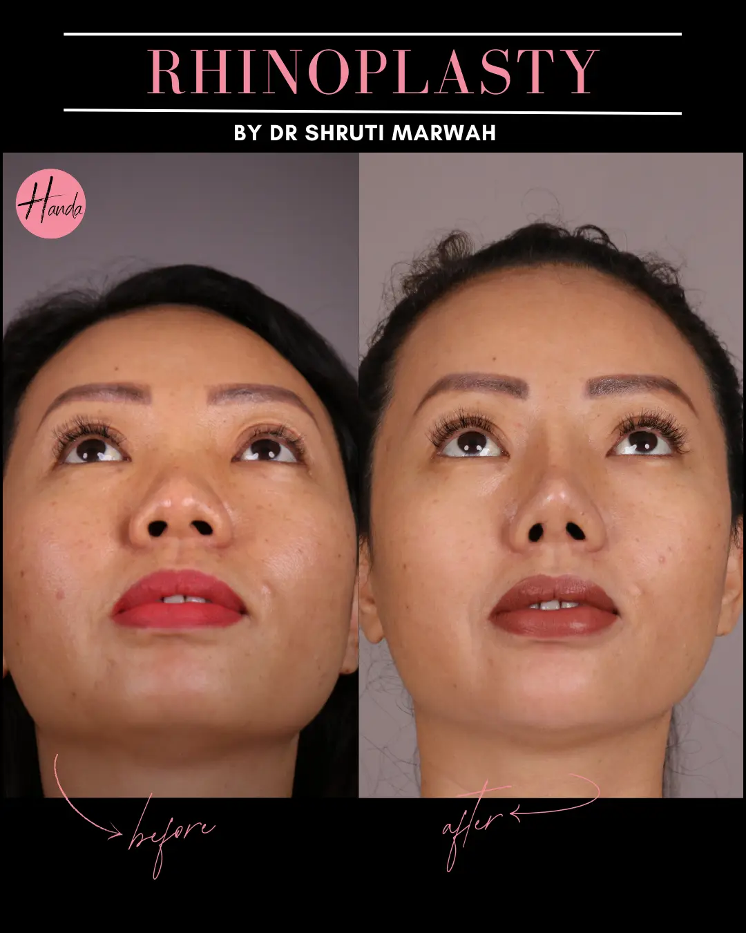 RHINOPLASTY before and after — Handa Aesthetics