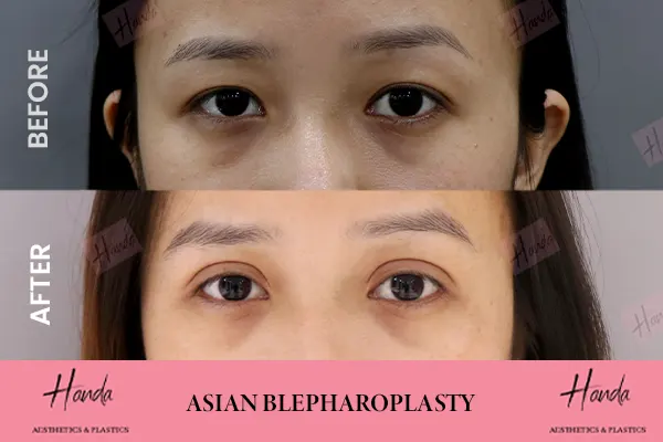 ASIAN BLEPHAROPLASTY before and after — Handa Aesthetics