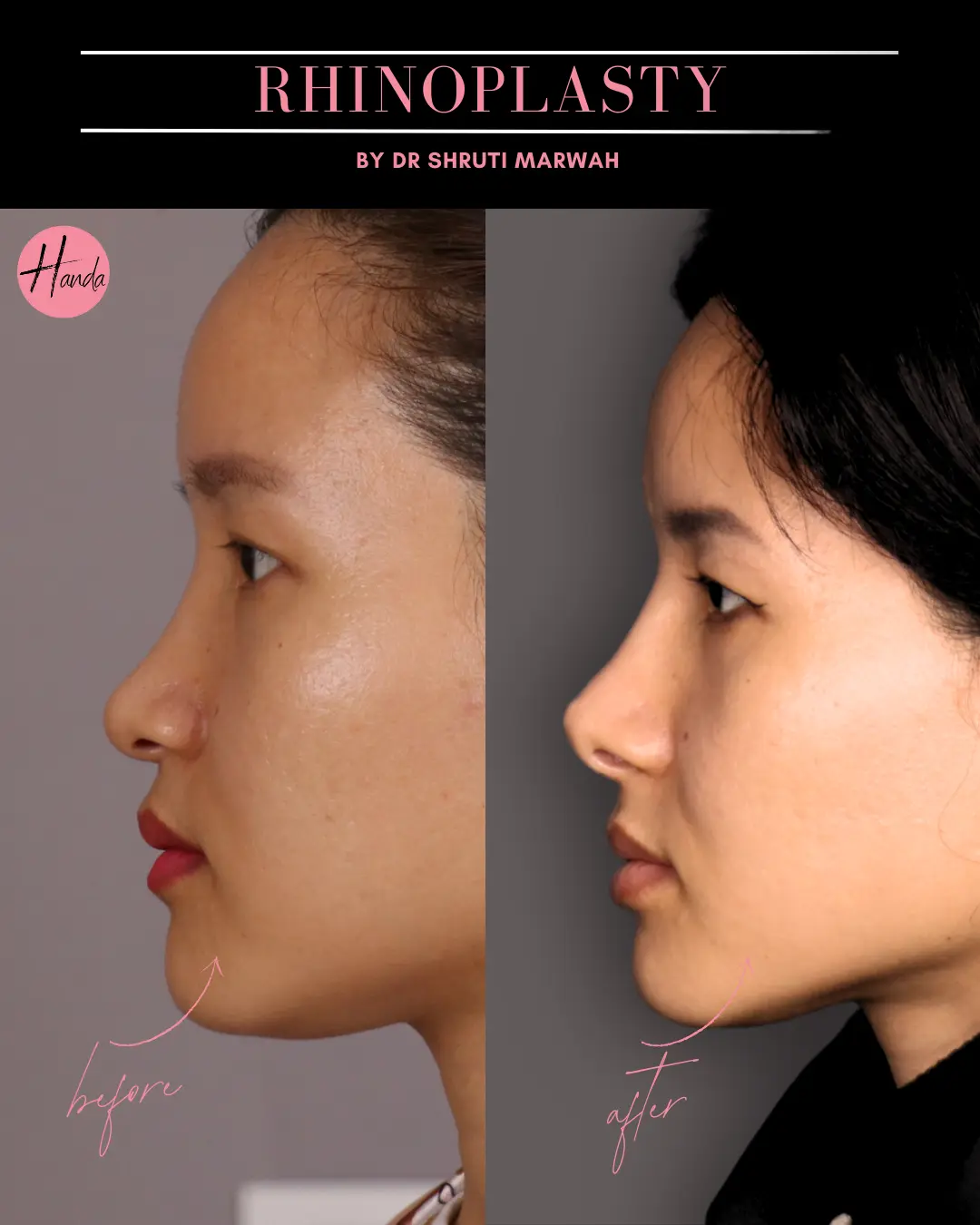 RHINOPLASTY before and after — Handa Aesthetics