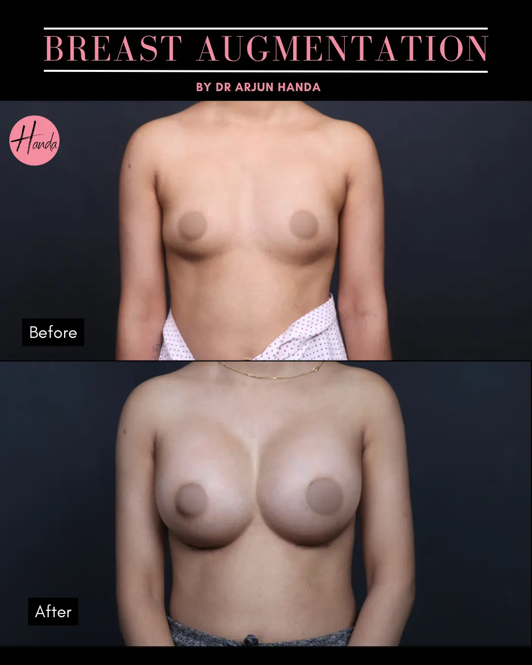 BREAST AUGMENTATION before and after — Handa Aesthetics