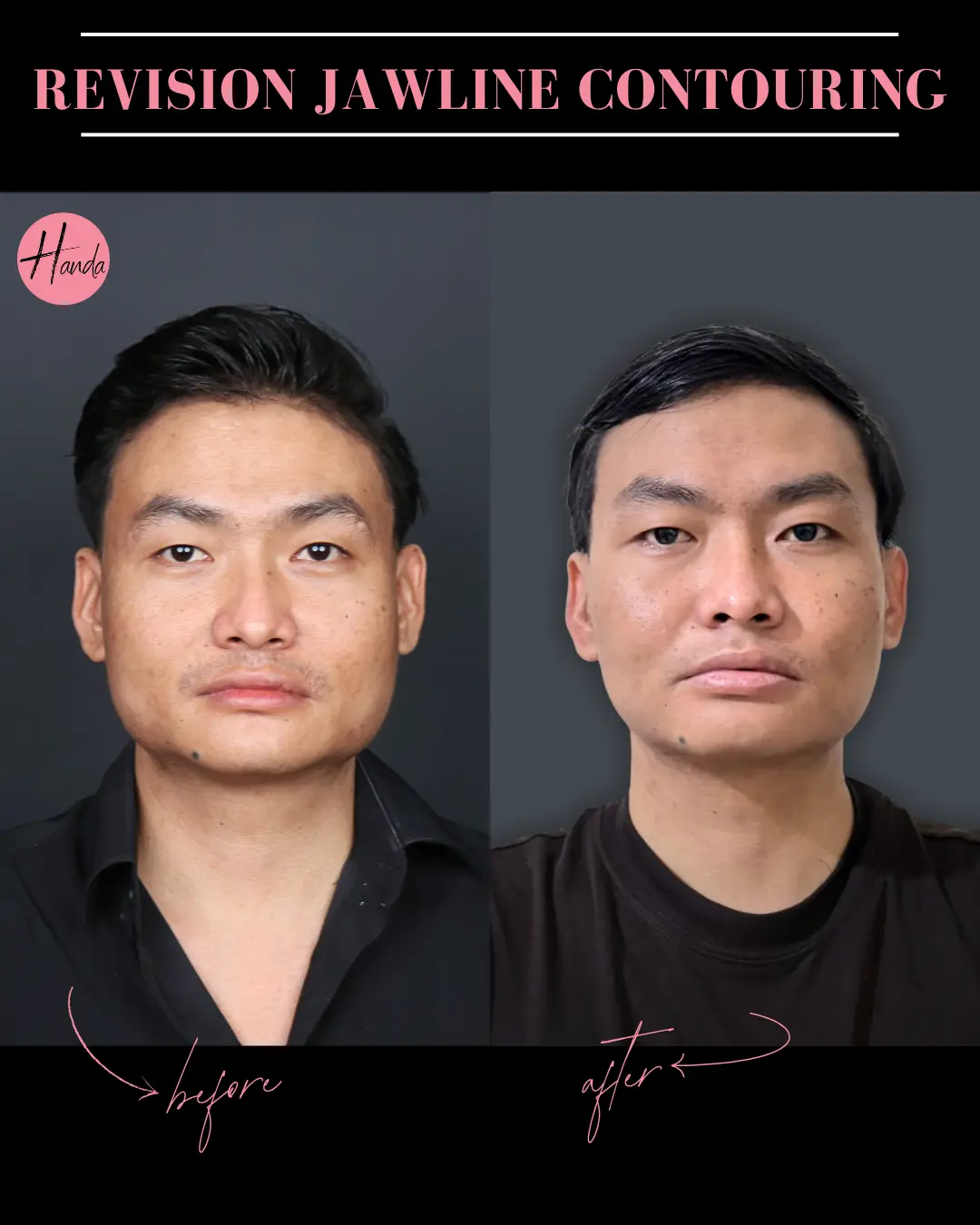 CHIN & JAWLINE LIPOSUCTION before and after — Handa Aesthetics