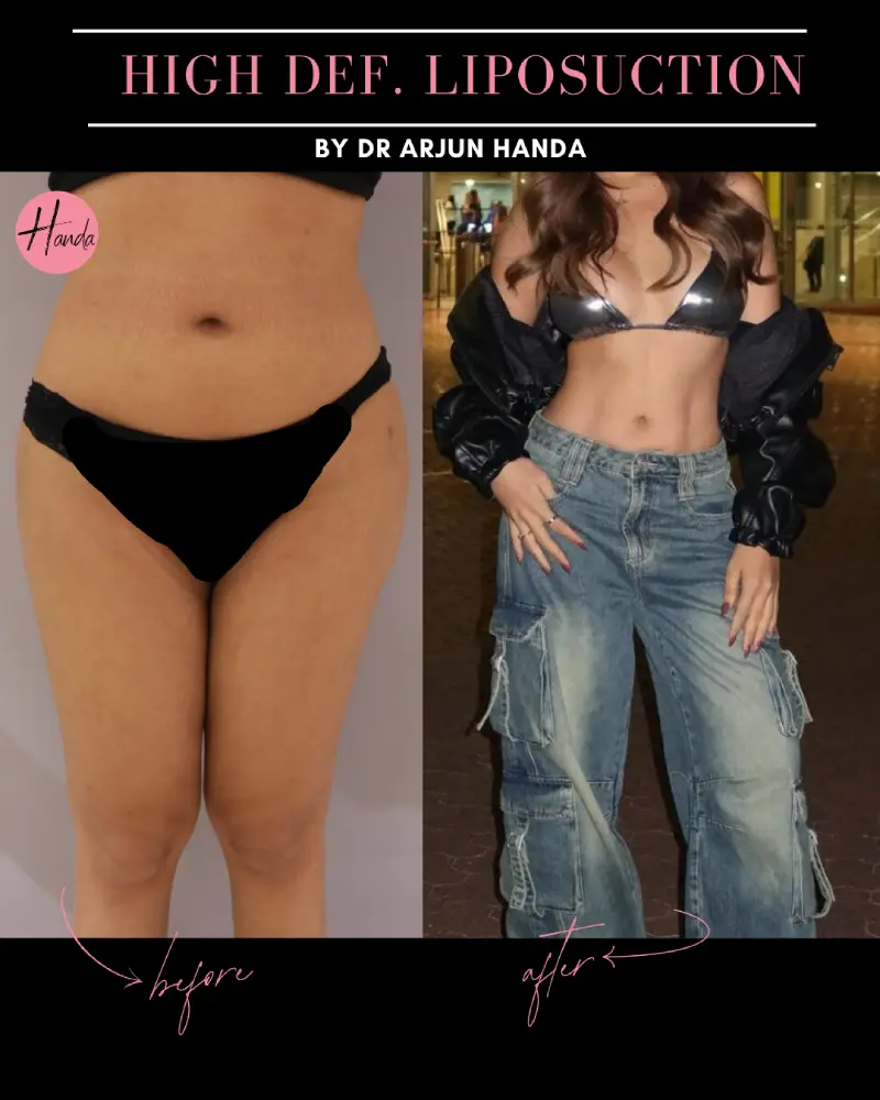 Liposuction before and after — Handa Aesthetics