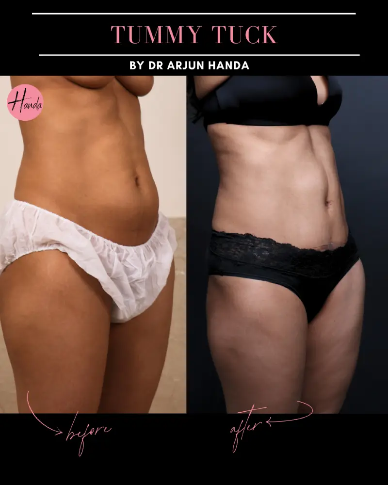 Tummy Tuck (Full Abdominoplasty) before and after — Handa Aesthetics